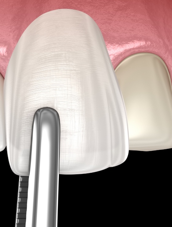 Illustrated veneer being placed over the front surface of a tooth